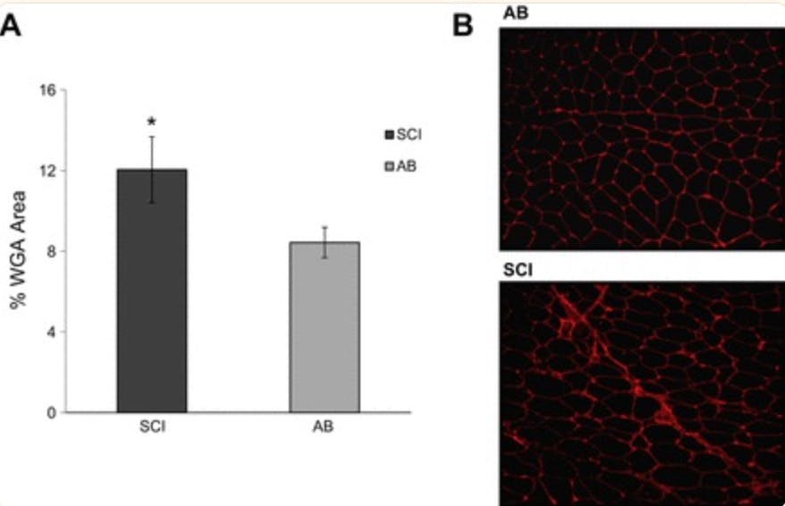 Heightened TWEAK-NF-κB signaling and inflammation-associated fibrosis in paralyzed muscles of men with chronic spinal cord injury