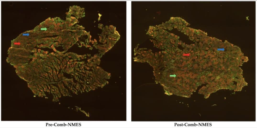 Figure from: Impact of Combined Neuromuscular Electrical Stimulation (Comb-NMES) on Glucose Signaling and Muscle Myofiber Distribution in a Patient with Acute Spinal Cord Injury and Lower Motor Neuron Lesion